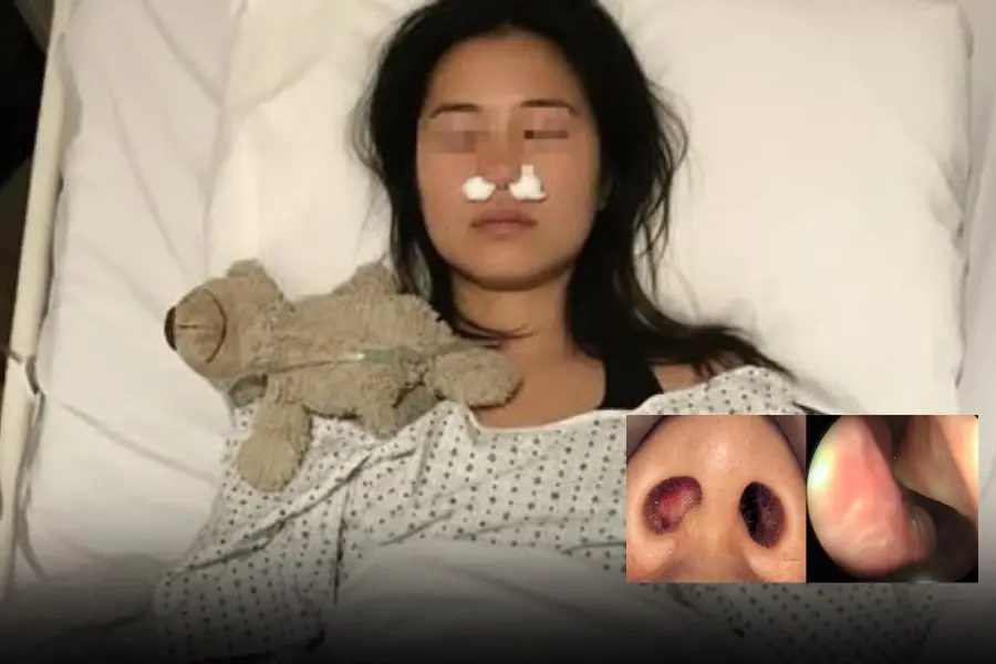 She grew a cluster of fungi in her nose — all because of a habit nearly everyone does daily
