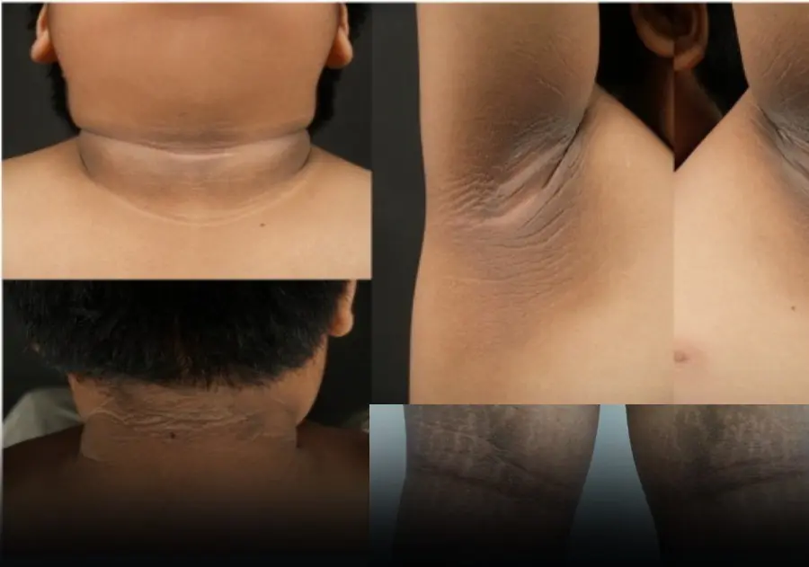 It commonly occurs in healthy people, but in some cases it can be a sign of an underlying disease.