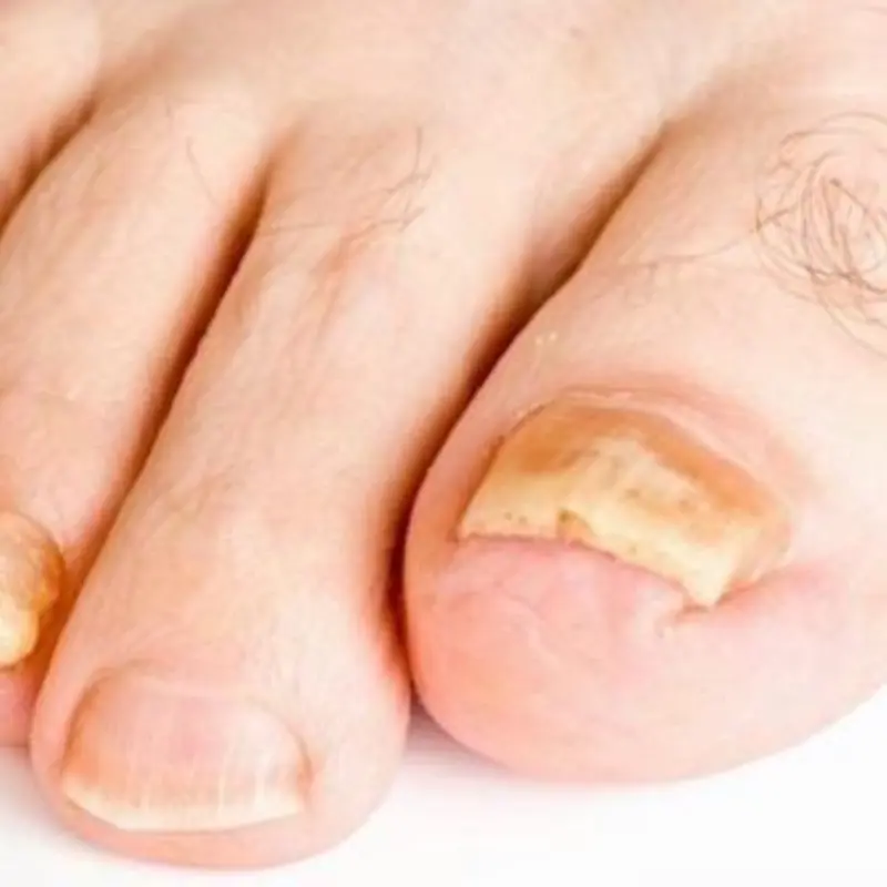 Two Subtle Foot Signs That Could Signal a Silent Ki.l.ler