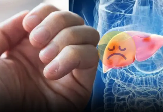 Don’t Ignore These 3 Hand Clues of Possible Liver Trouble