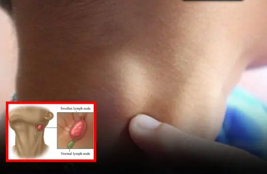 Don’t Ignore Swollen Lymph Nodes in the Neck — Know the Signs