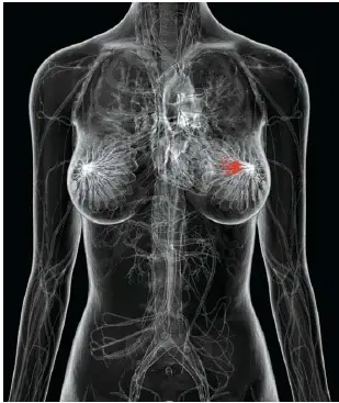 4 Early Warning Signs of Bre.ast Can.cer Women Should Never Ignore