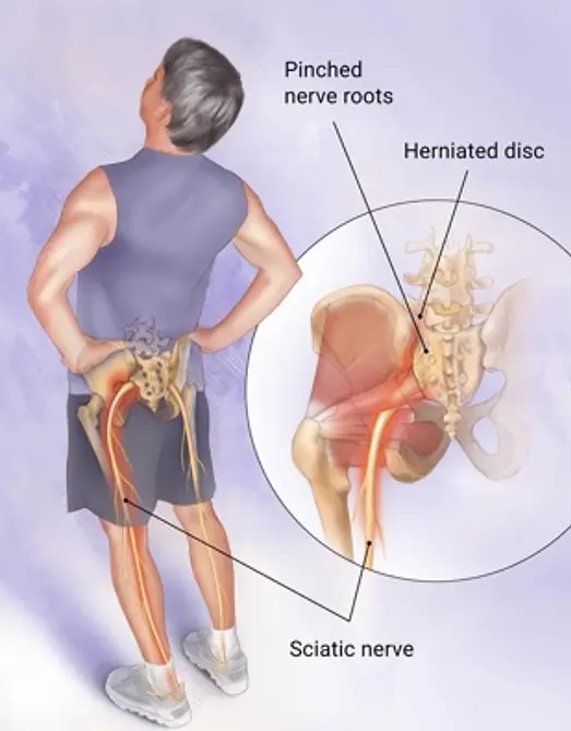 How to Soothe Sciatic Nerve Pain: A Complete Guide to Natural Remedies