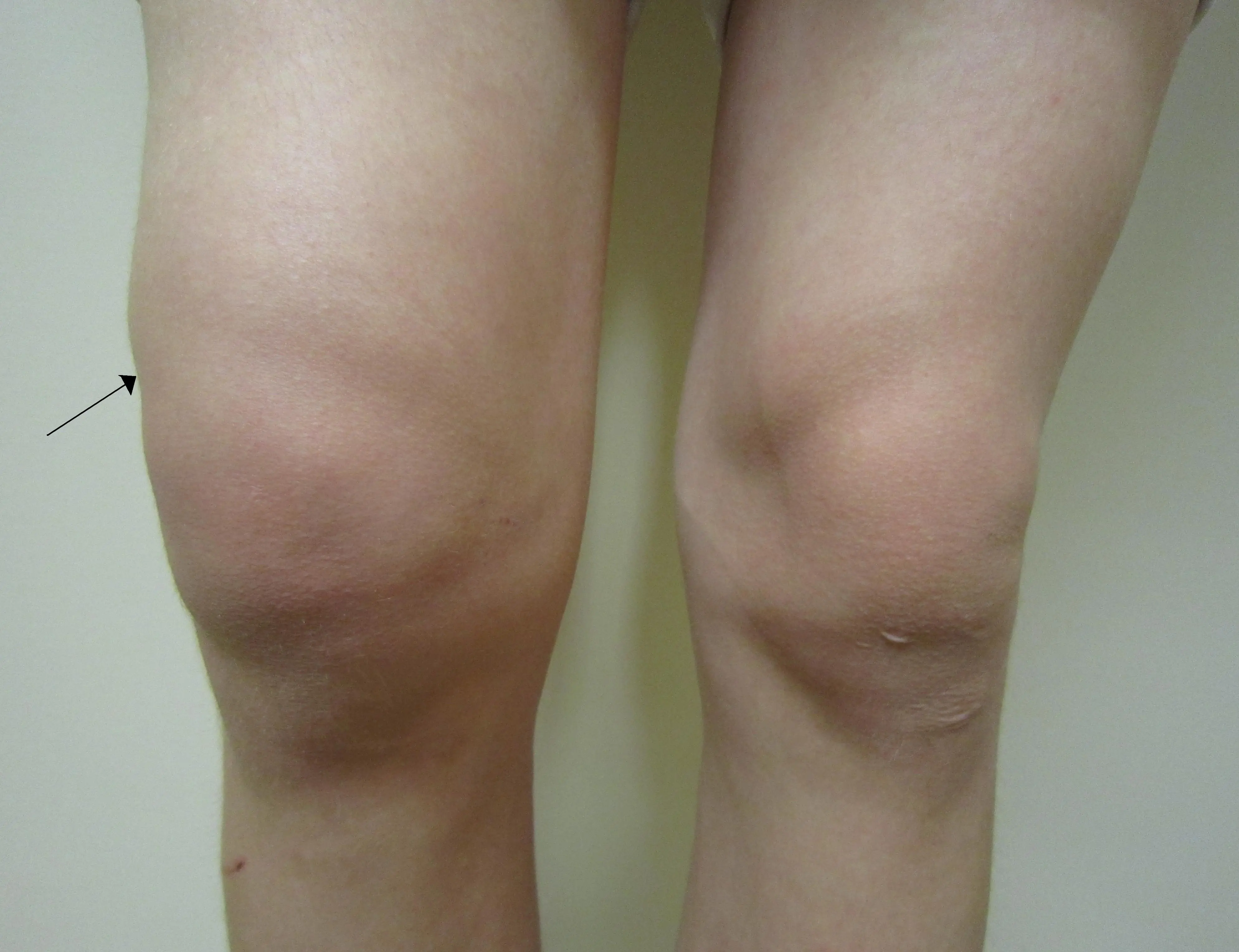 Knee Osteoarthritis: Recognize These 5 Common Symptoms Early