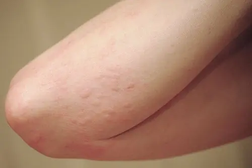 He thought it was a simple allergy. But the itching was actually a warning sign