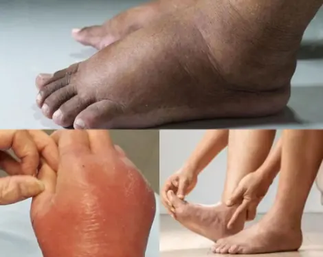 Foods That May Help Reduce Swelling in Your Hands and Feet