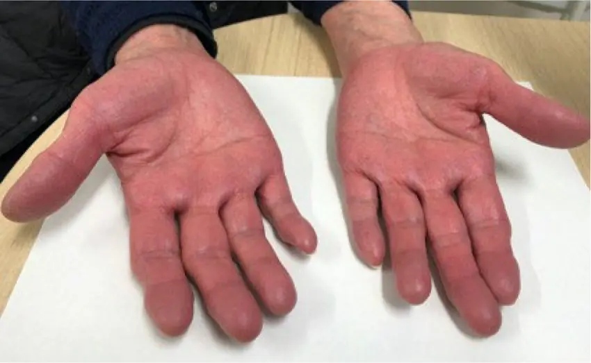 Be Cautious if You Notice Red Palms or Unusual Redness