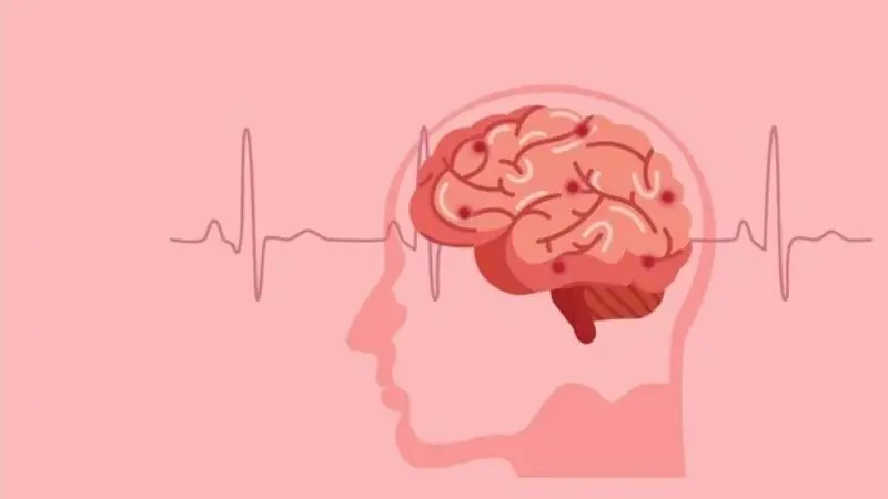 5 Potential Complications of Cerebral Ischemia and How to Reduce the Risk