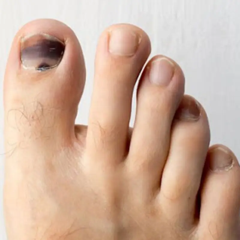 Causes of a Black Toenail and the Right Way to Handle It