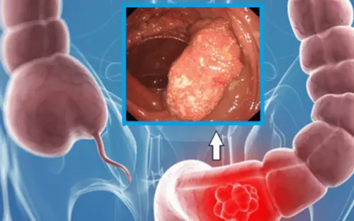 Colon Polyps and Can.cer Prevention: Why Early Detection Matters