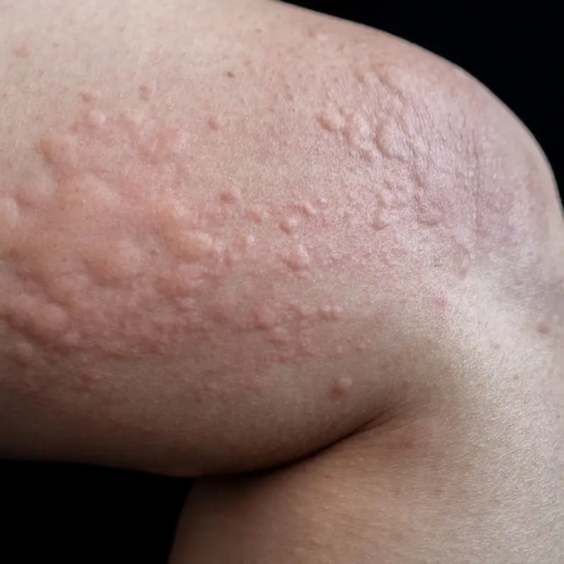 His Whole Body Was Itchy. He Thought It Was Just an Allergy — but the Diagnosis Said Otherwise.