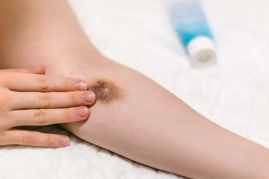 5 dark spots on your skin that could be warning signs of can.cer - symptoms many people overlook