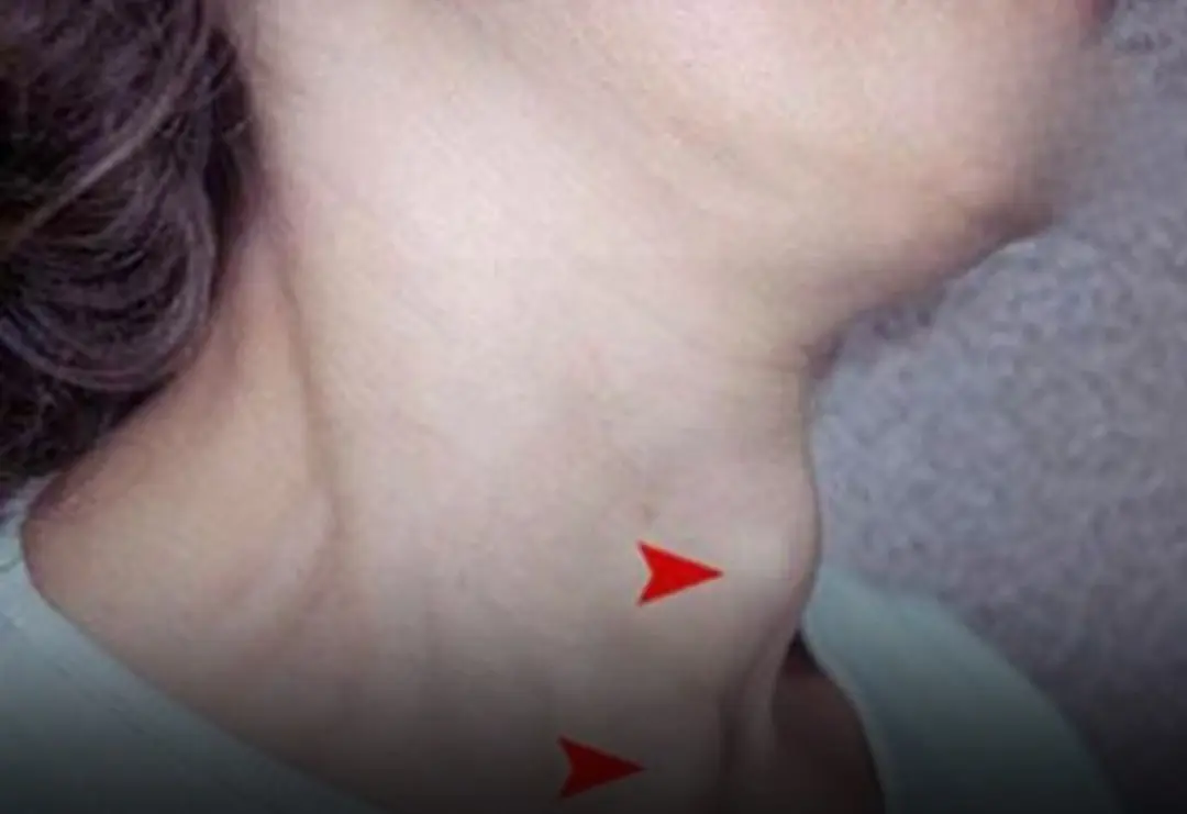 5 Warning Signs of Thyroid Can.cer You Shouldn't Ignore