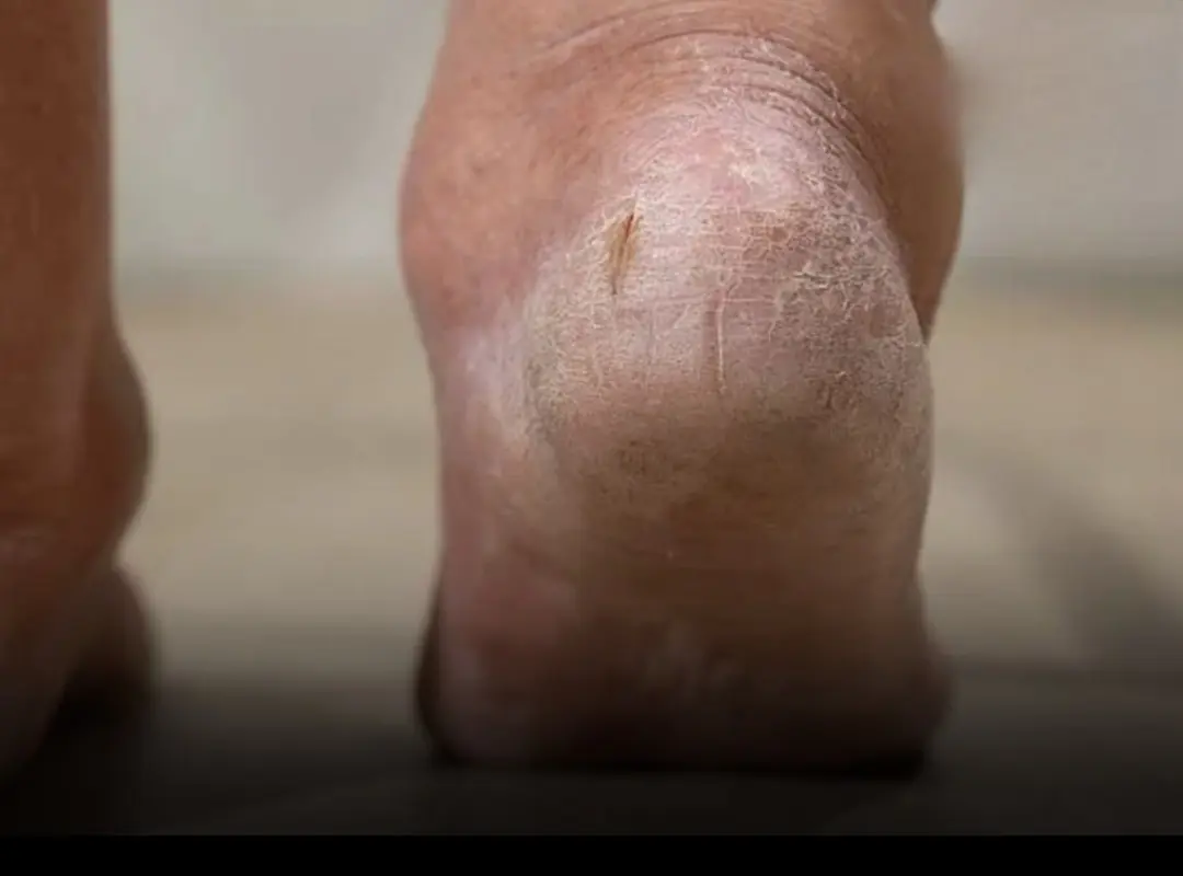 5 Strange Foot Symptoms That Could Signal Kidney Trouble