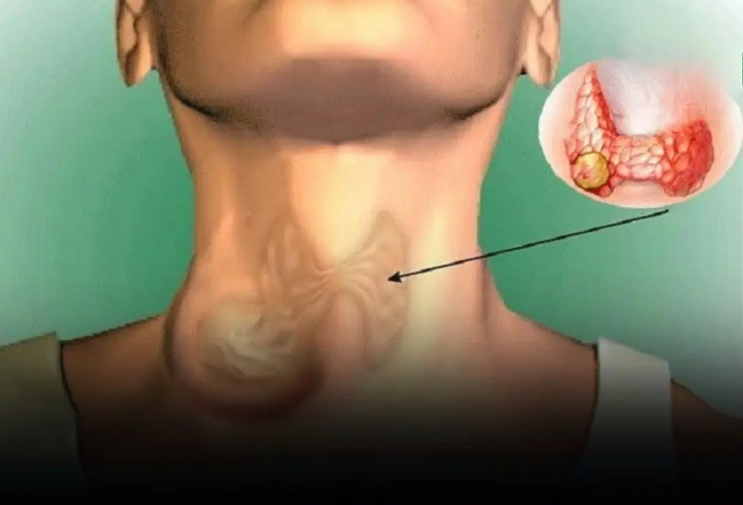 These 2 Supplements Might Be Accelerating Thyroid Canc.er Without You Knowing