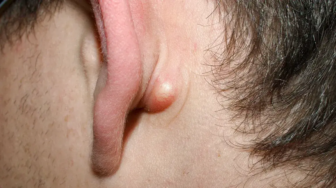 Lumps and Cysts: Signs, Causes, and Essential Care for Your Health