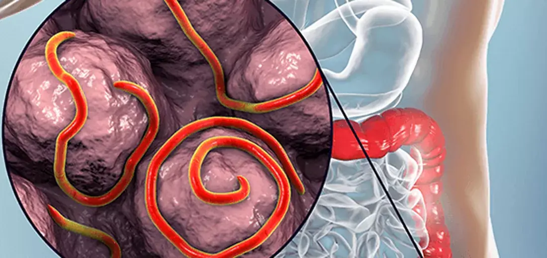 7 Foods That May Help Kil.l Intestinal Worms Naturally