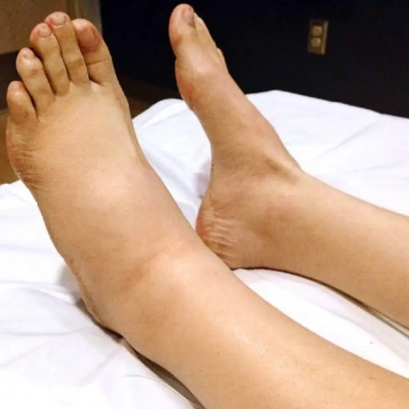 Can Your Feet Signal Early Cervical Cancer? Watch for These 4 Signs