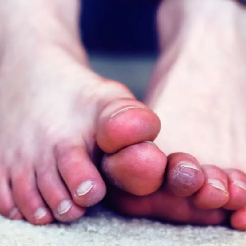 Nighttime Warning Signs of Blocked Arteries in the Legs and Feet