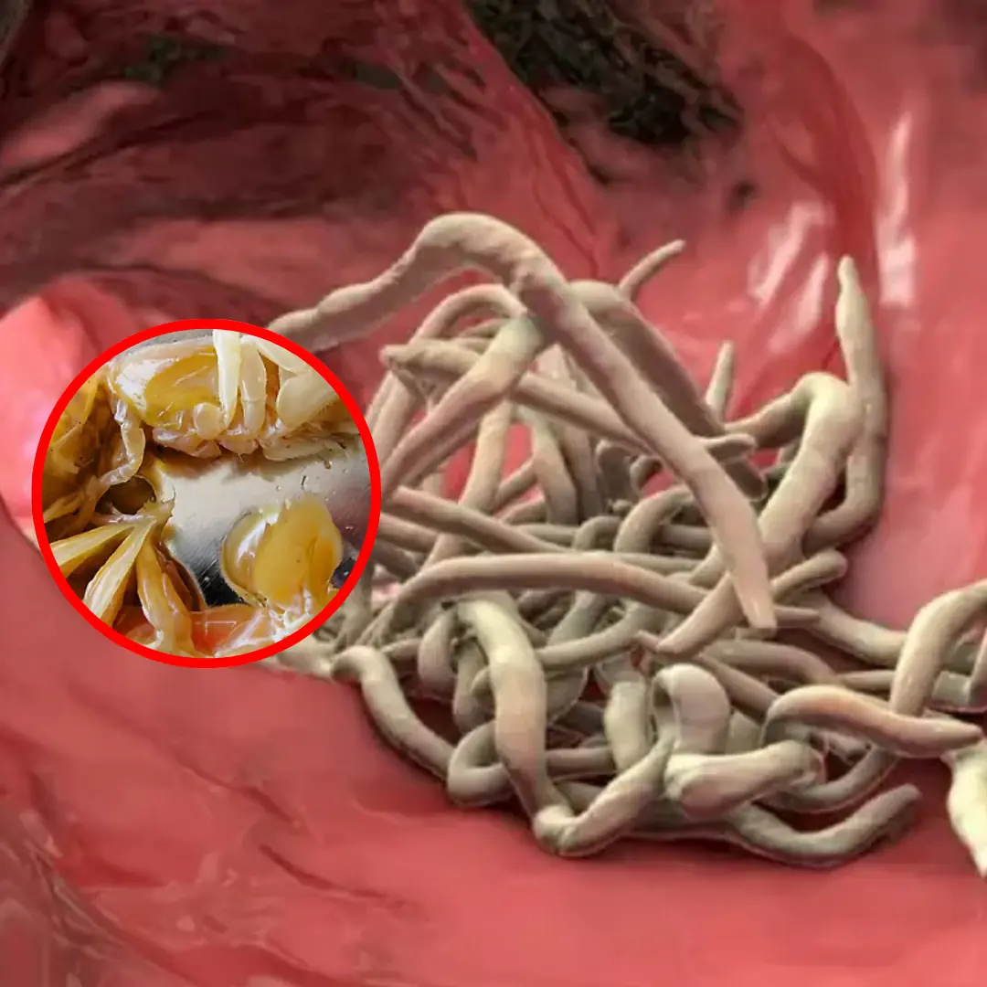 Doctors Reveal 4 Everyday Foods That May Be Crawling with Parasites
