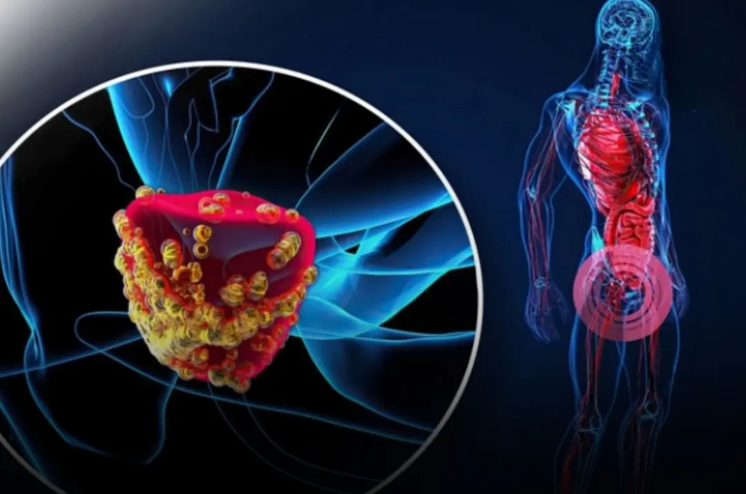 B l a d d e r c a n c er - obvious signs you should pay attention to