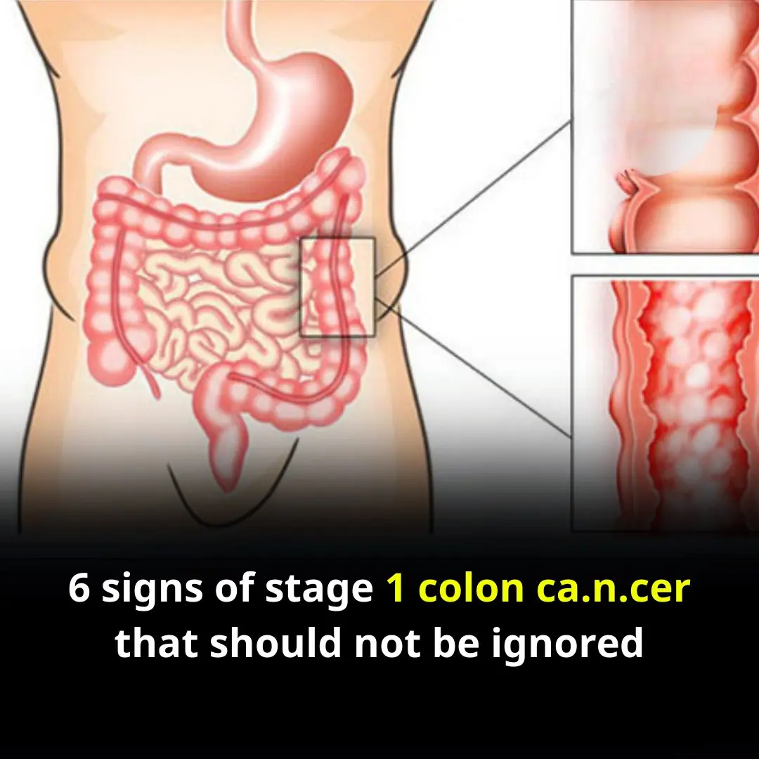 6 Silent Warning Signs of Early-Stage Colon Cancer You Shouldn’t Ignore