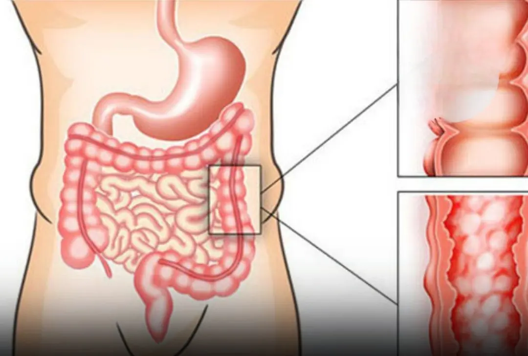 6 Silent Warning Signs of Early-Stage Colon Cancer You Shouldn’t Ignore