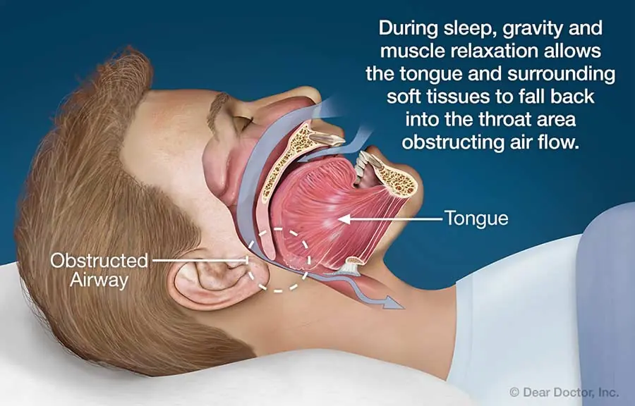 Snoring and Your Health: What It Could Mean for Your Body and Well-Being