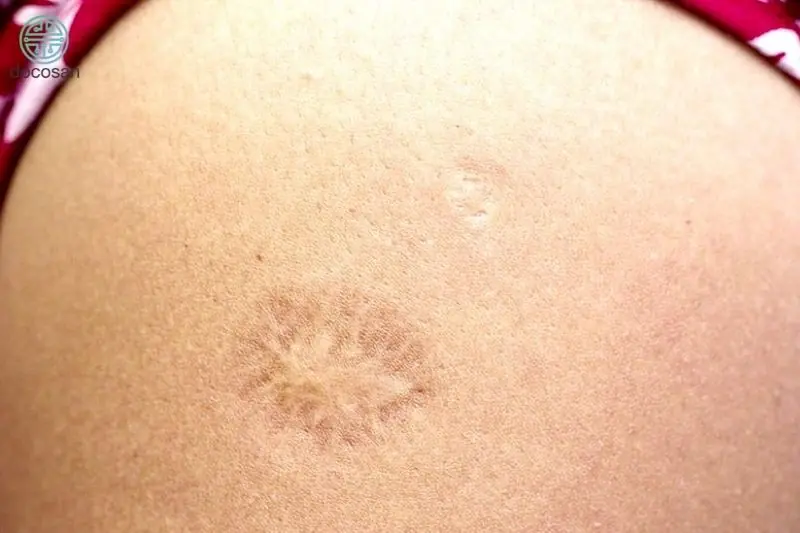 Do you know why there’s a small scar on the upper left arm and what it means?