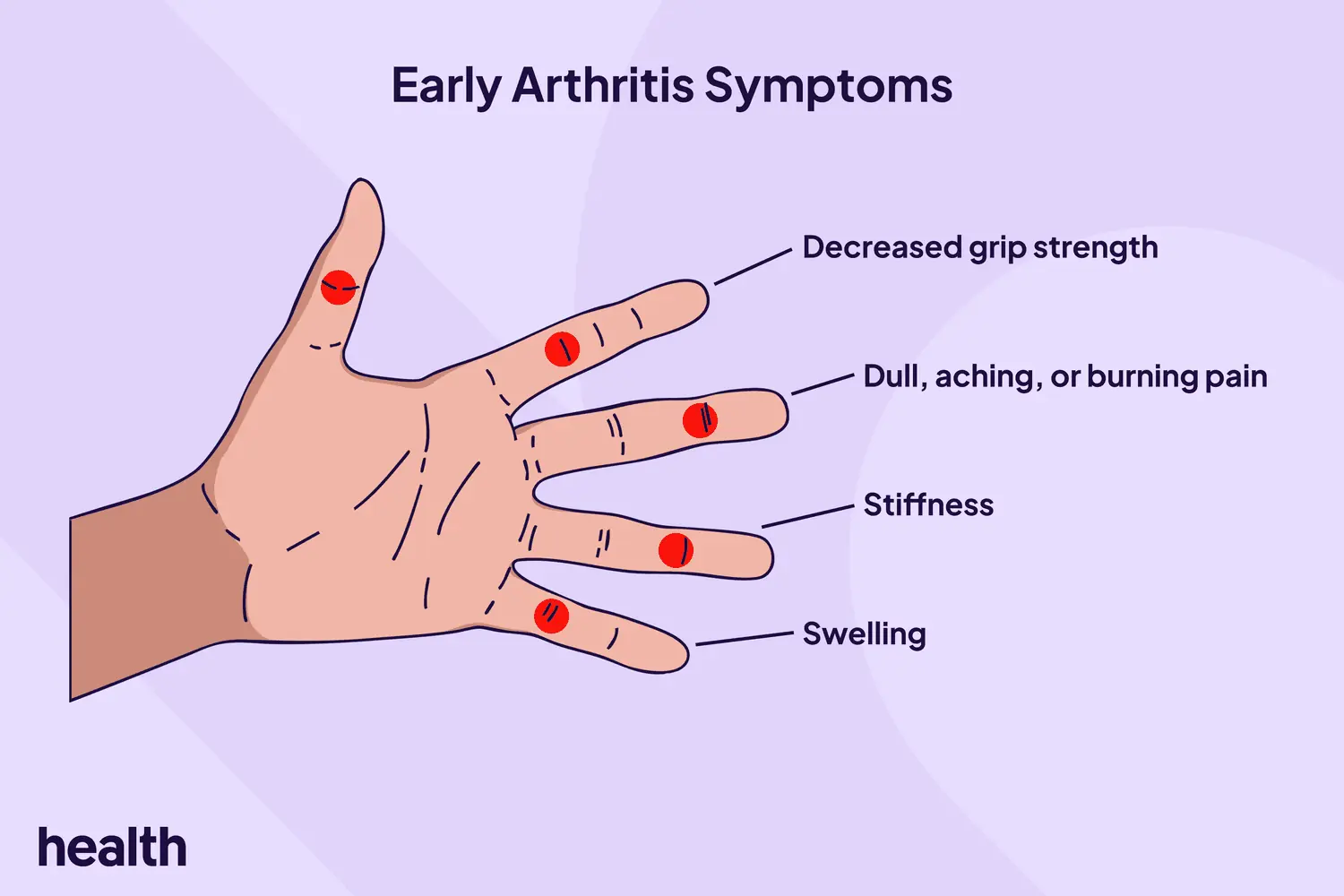 Common Symptoms of Arthritis and When to Seek Advice