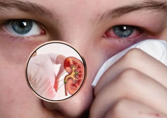 These 8 Kidney Warning Signs Could Indicate Serious Damage