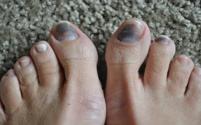 Why Toenails Turn Black — and What Actually Helps