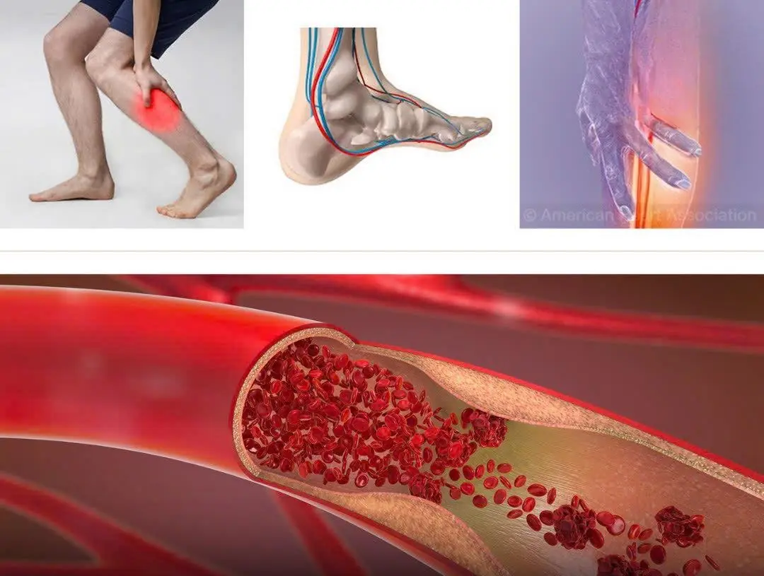 Heart Blockage Doesn’t Always Start in the Chest — These Nighttime Foot and Leg Signs Matter