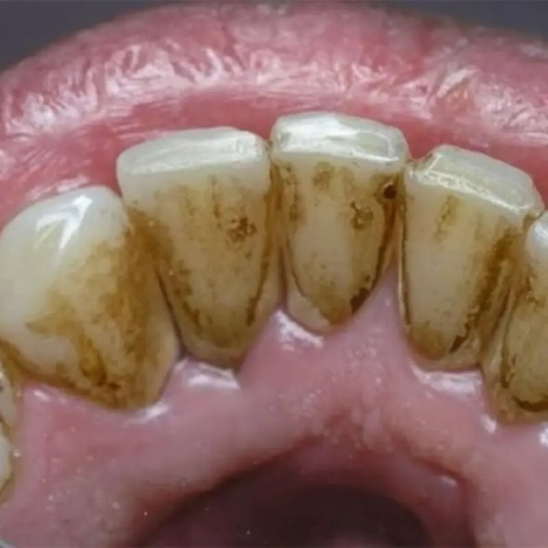 Effective Teeth Whitening Tips Using Simple Kitchen Ingredients