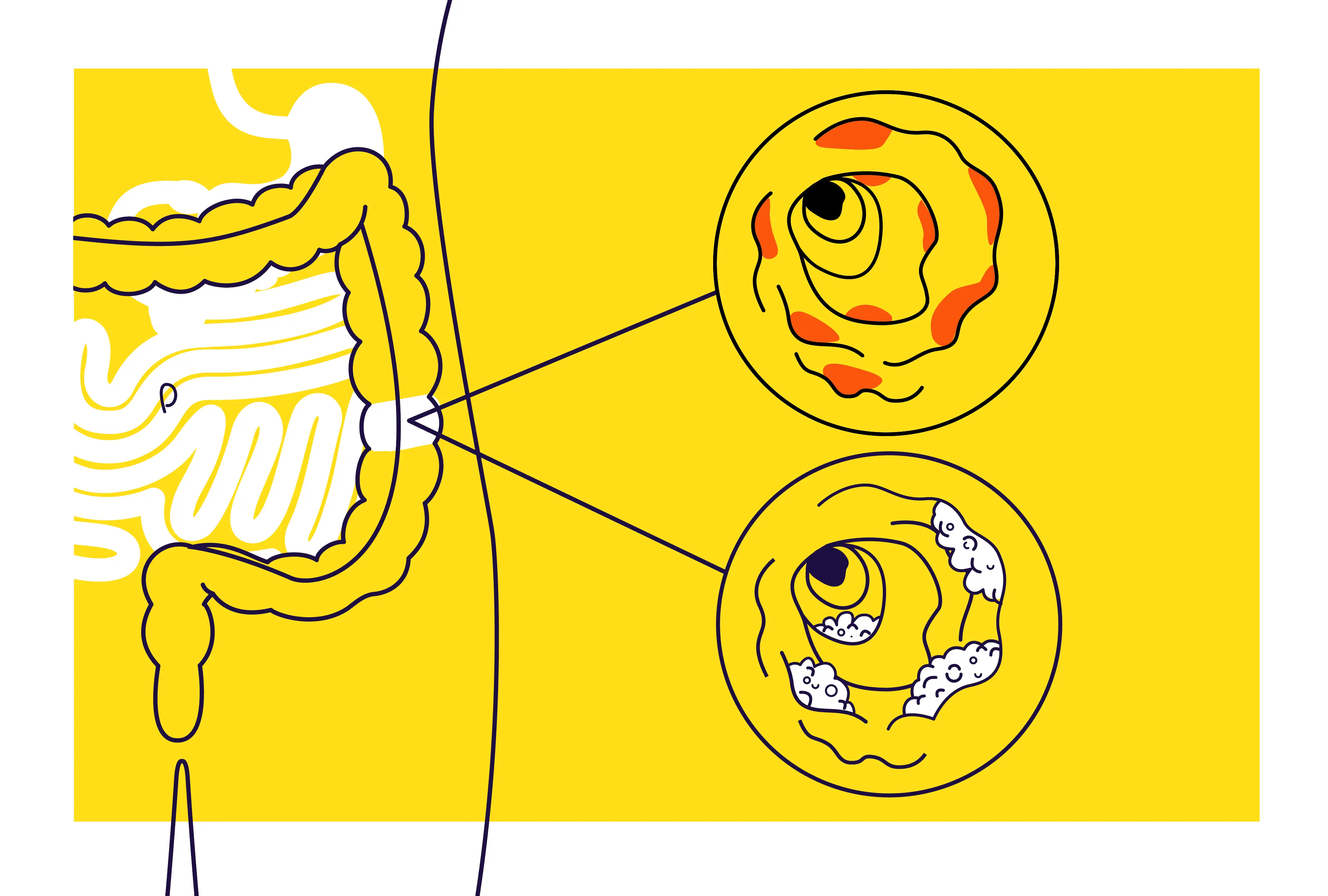 When Digestive Problems Don’t Go Away: Early Signs of IBD to Watch For