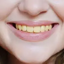 Think Brushing Is Enough? A Dentist Reveals Why Teeth Still Turn Yellow