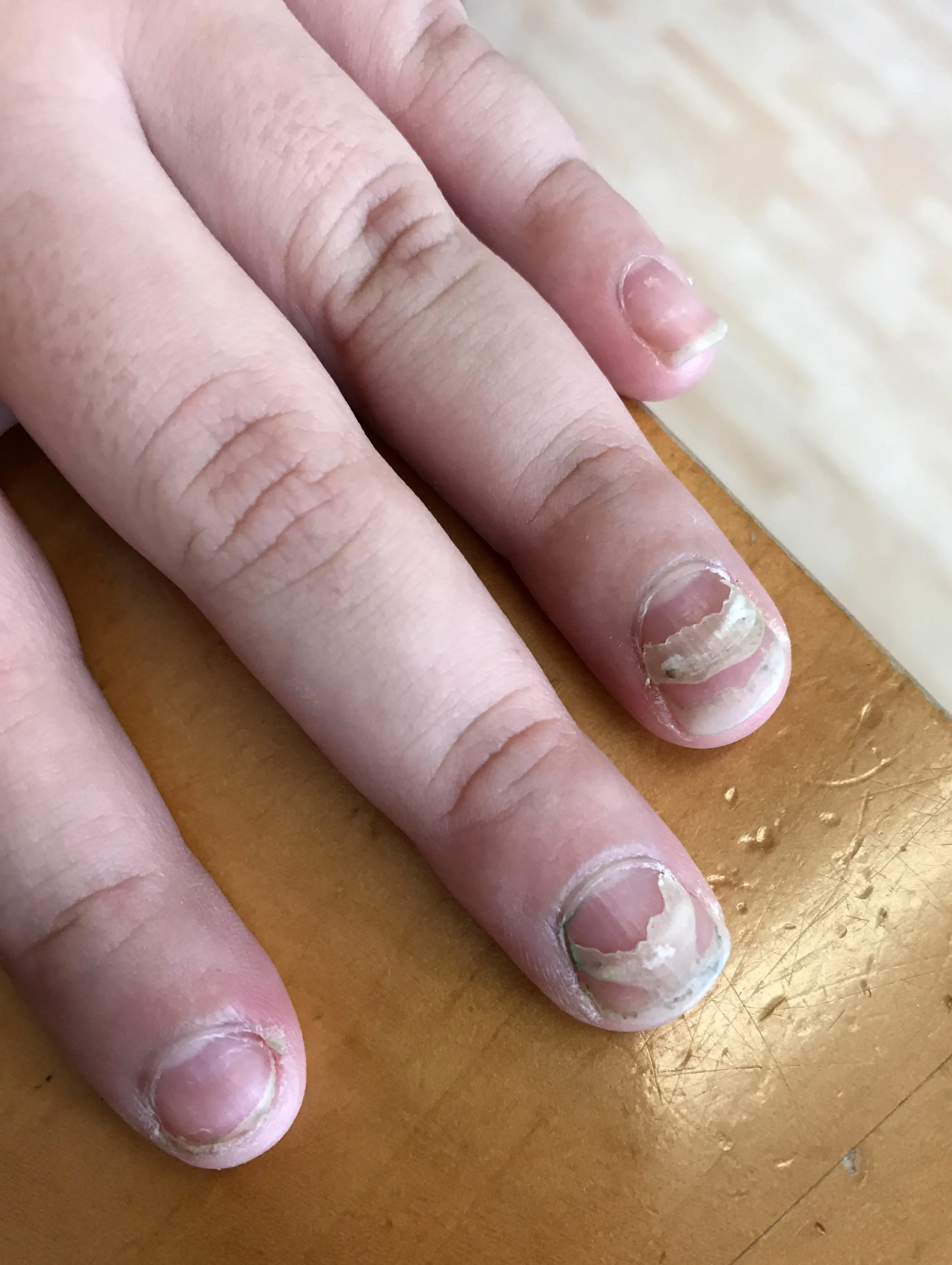 If Your Nails Won’t Stop Splitting, Don’t Ignore These Possible Causes