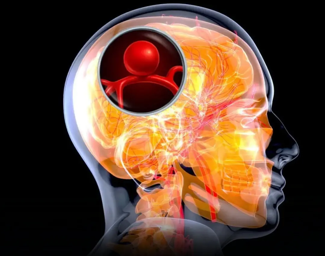 Brain Aneurysm: 12 Warning Signs You Must Not Ignore