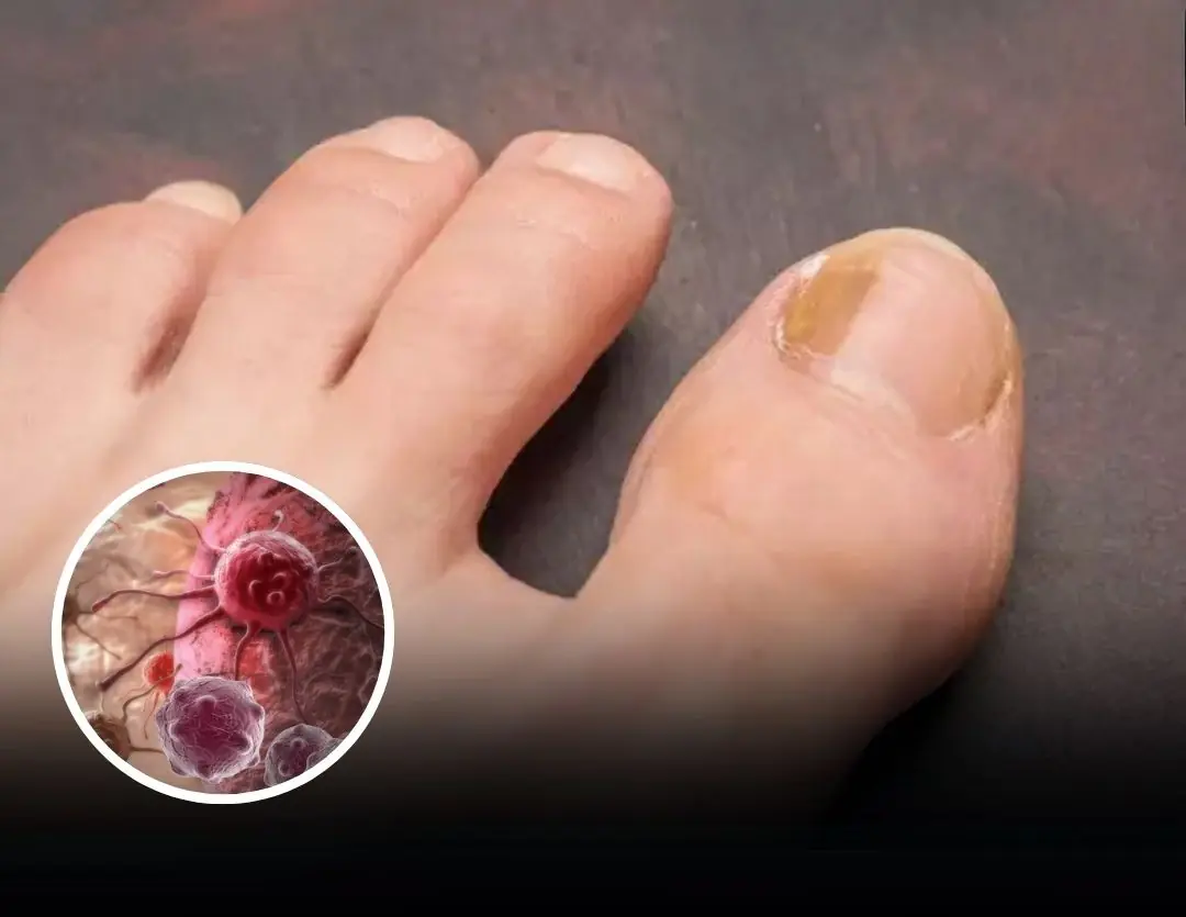 Can:cer Warning: Doctors Reveal Little-Known Sign on Toenails