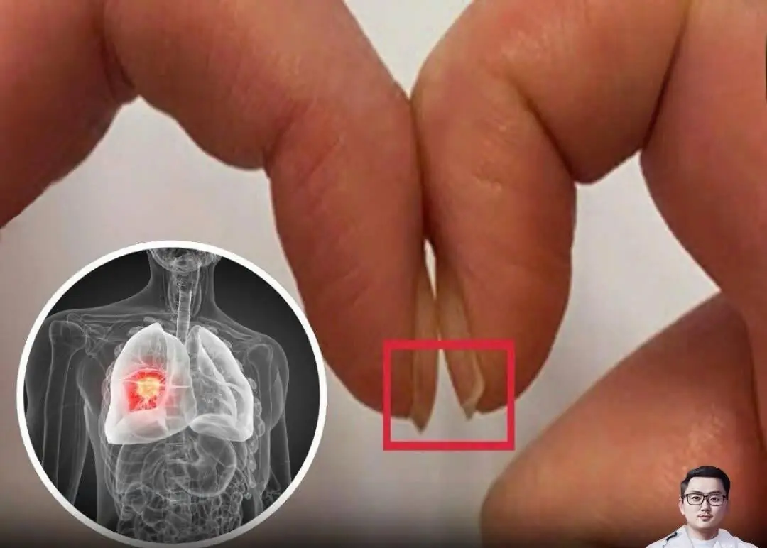 This simple fingernail test could help save your life