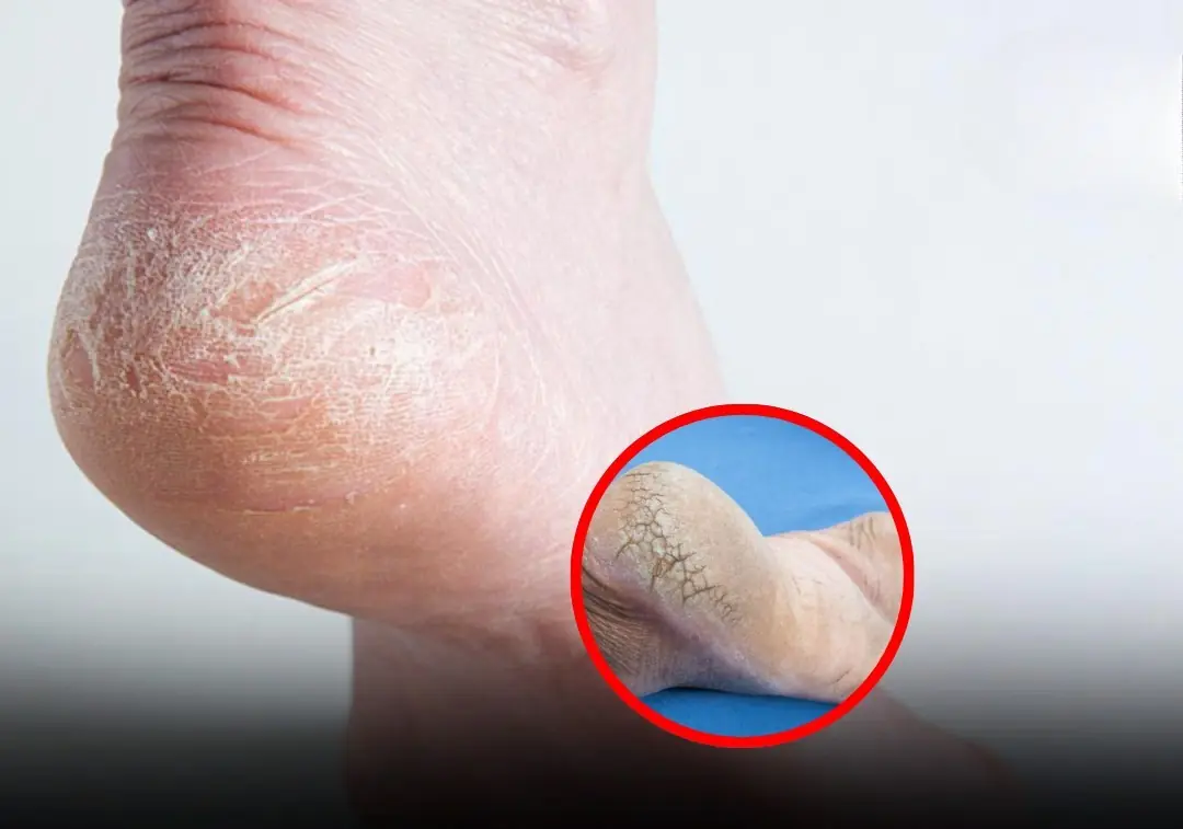 A Pharmacist Shares a Warning Sign in Your Heel That Could Be a Symptom of a Serious Condition