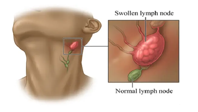 When Are Swollen Lymph Nodes in the Neck a Cause for Concern?