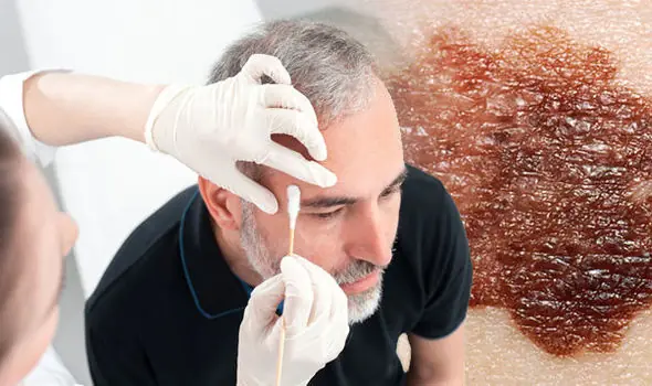 Early Signs of Skin Cancer: The Significance of a Large or Changing Spot