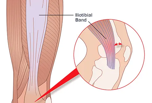 Muscle pain behind the knee, a dangerous symptom that should not be ignored