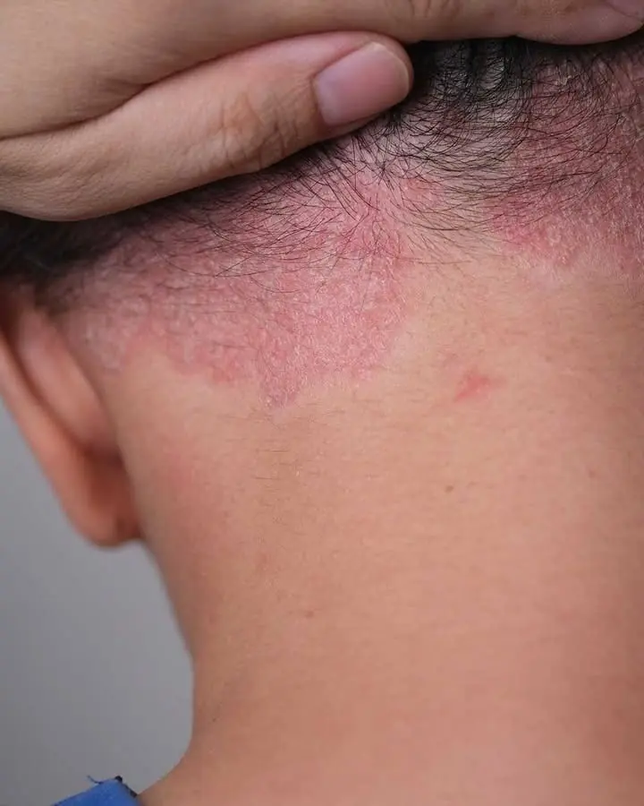 I Found a Red Spot on My Grandson’s Skin — Why Everyone Is Panicking and What to Do