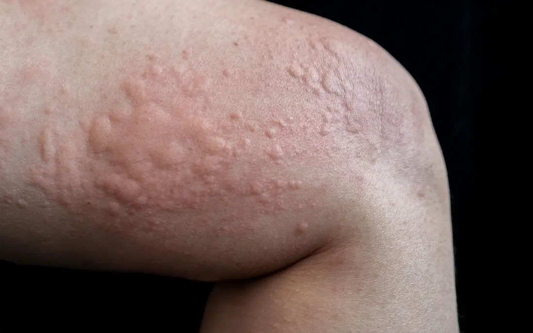 When Itchy Skin Comes with Bumps: What It Could Really Mean