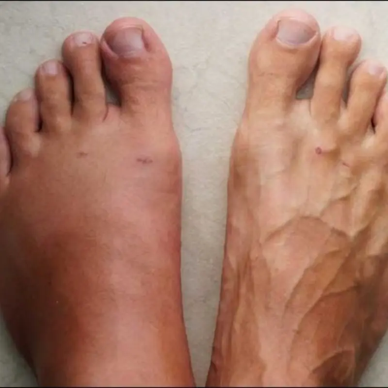 If Your Feet and Hands Are Swollen, Here’s What Your Body Is Trying to Tell You