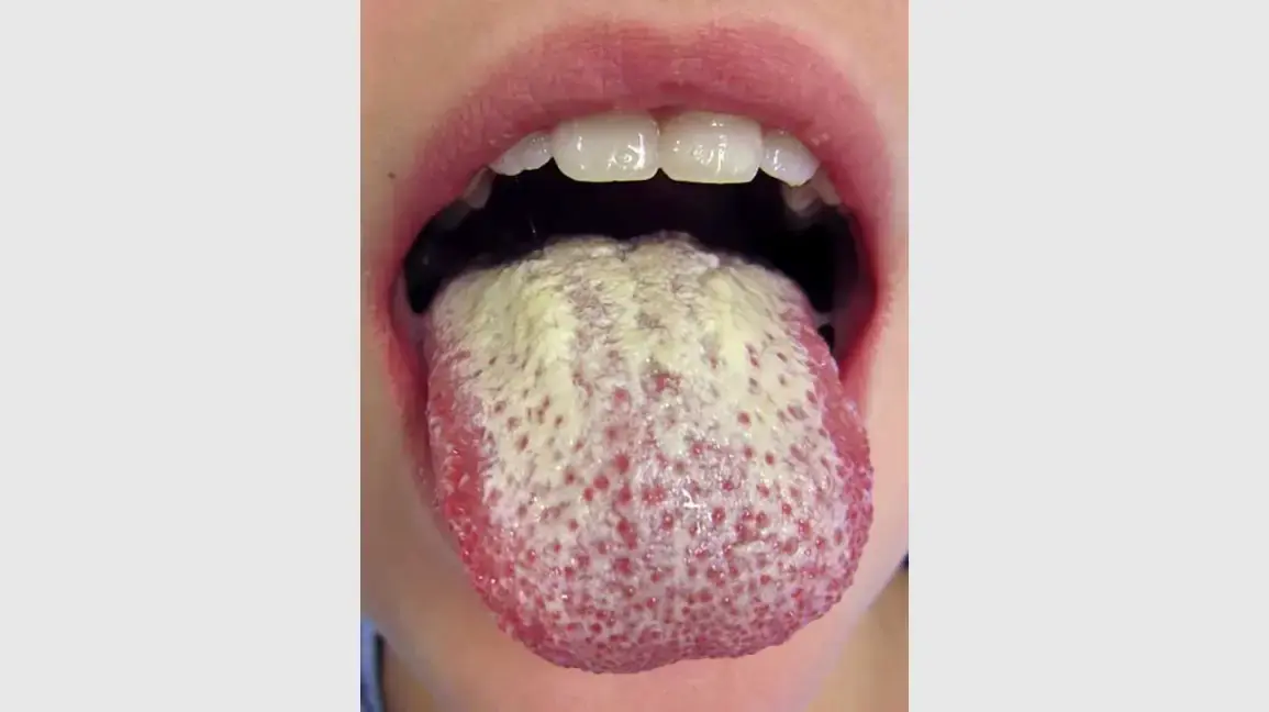 Why Is Your Tongue White? What It Says About Your Health