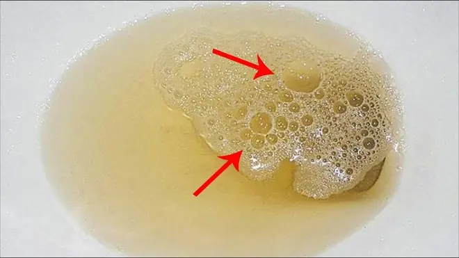 If You Notice These 3 Urine Symptoms, See a Doctor Immediately