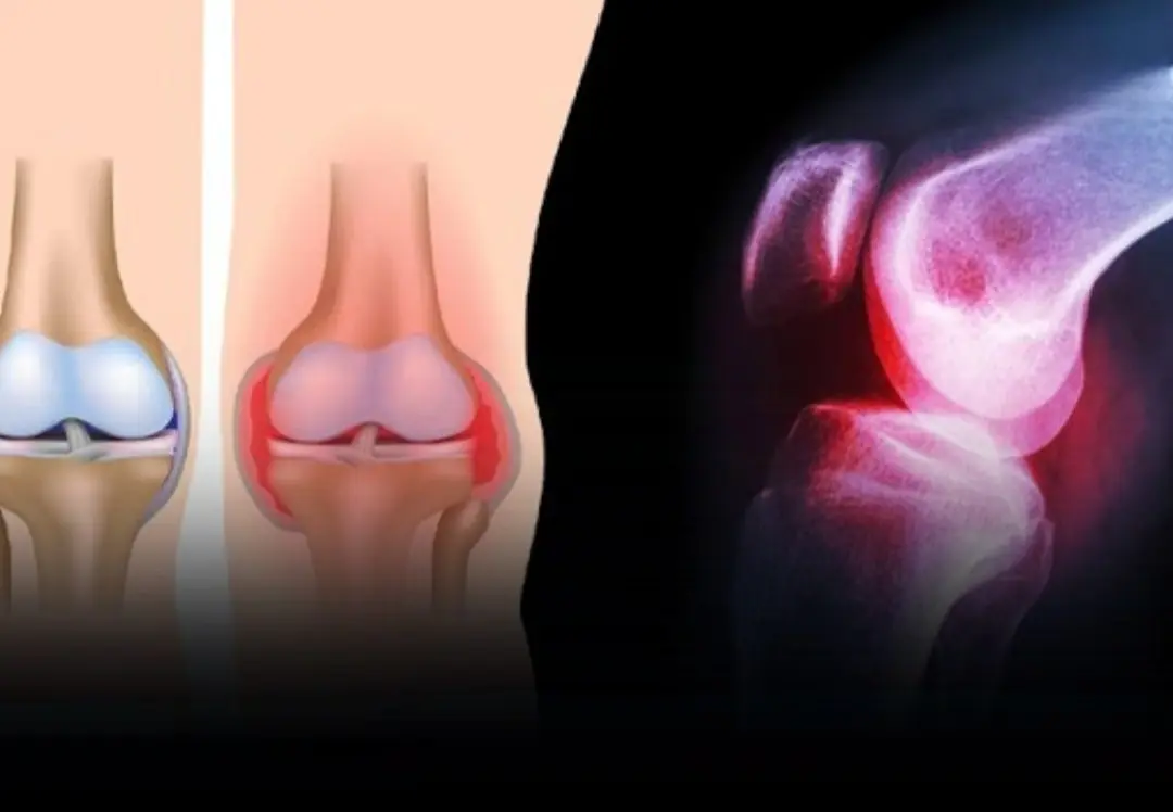 Warning: These 6 Foods Can Quietly Drain Calcium From Your Body — The More You Eat, the Weaker Your Bones Become